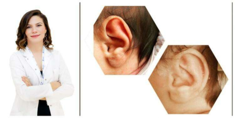 Bebeklerde Kulak Şekil Bozuklukları Sorun Olmayacak